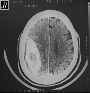 Hematoma Subdural Hematoma 39 Radioogle