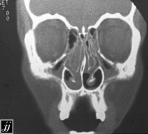 Radioogle Ent Bi Lateral Concha Bullosa Sinusitis And Maxillary