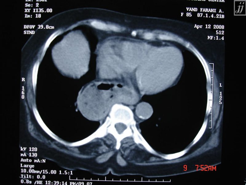 Abdomen Hiatal Hernia 2 Radioogle