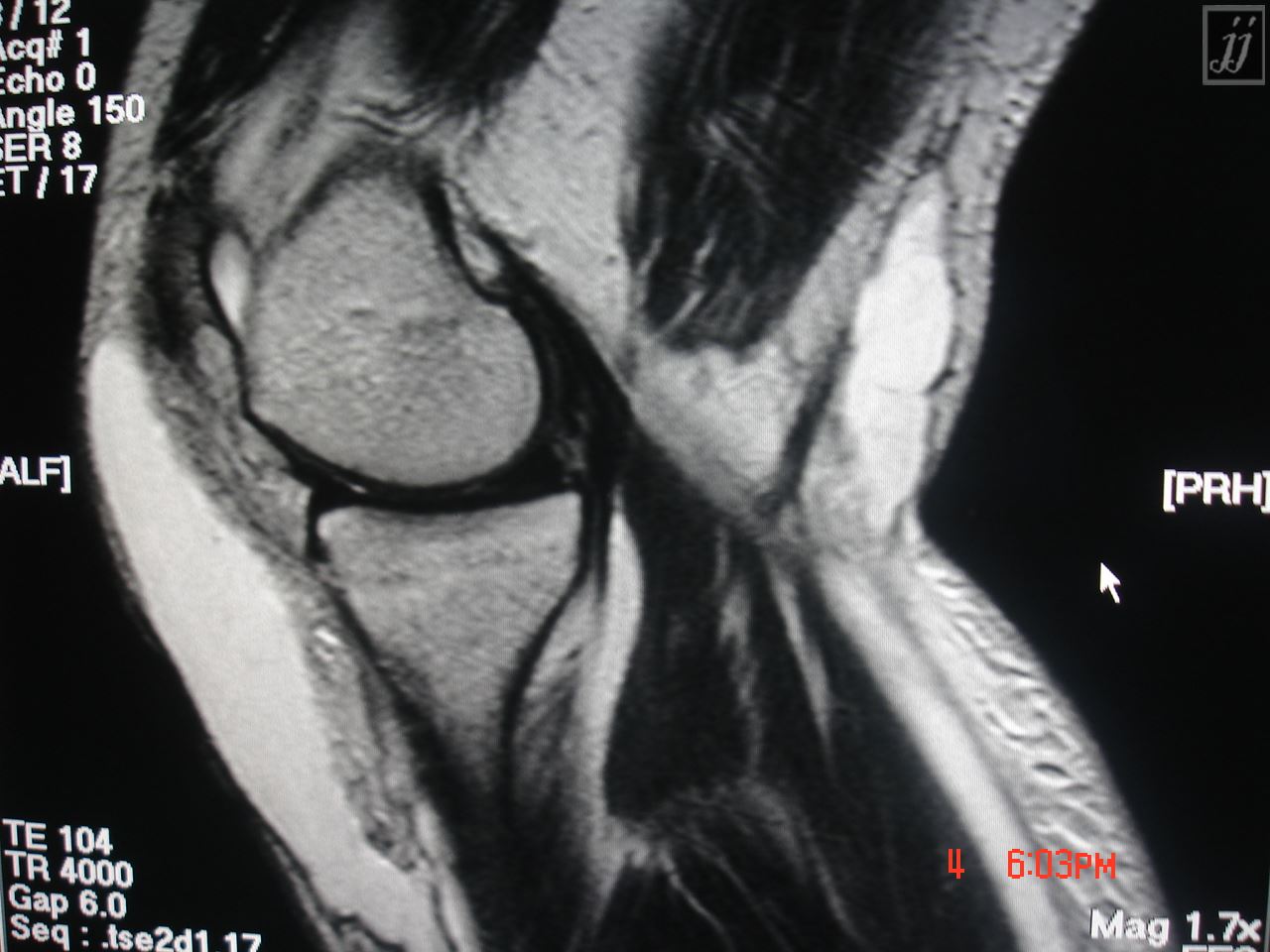 Radioogle Msk Popliteal Cyst And Hemorrhage Around Gastrocnemius