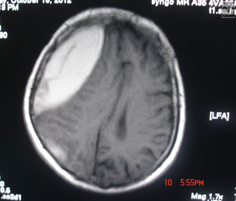 Brain Subdural Sub Acute Extracellular Met Hemoglobin Hematoma 1