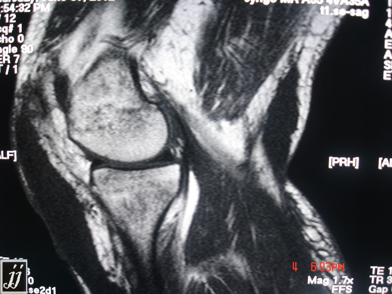 MSK Popliteal Cyst And Hemorrhage Around Gastrocnemius Muscle And Pre