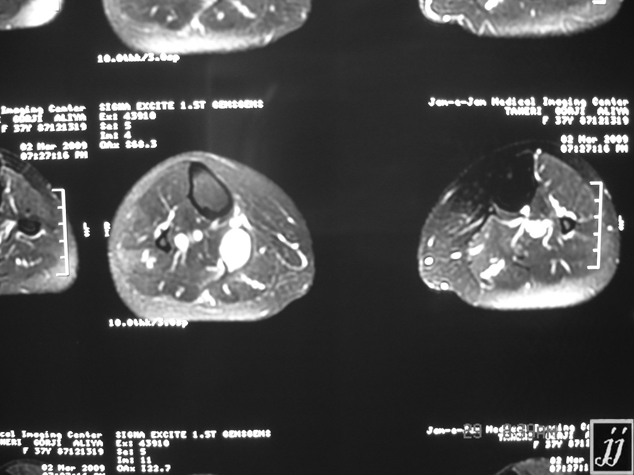 MSK Posterior Tibia Muscle Hemorrhage And Partial Rupturing 5