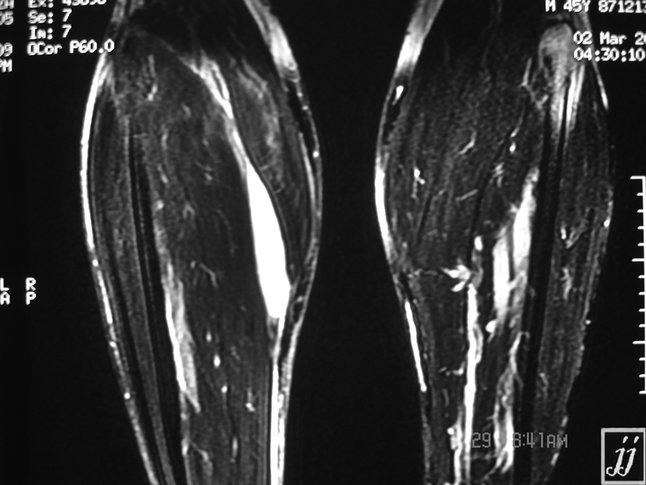 Msk Posterior Tibia Muscle Hemorrhage Between Gastrocnemius And Soleus