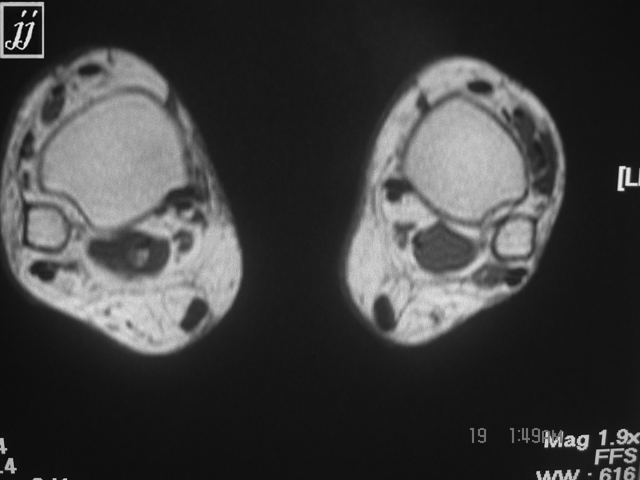 Msk Fluid Around Posterior Tibial Tendon Vs Ganglion Cyst Radioogle