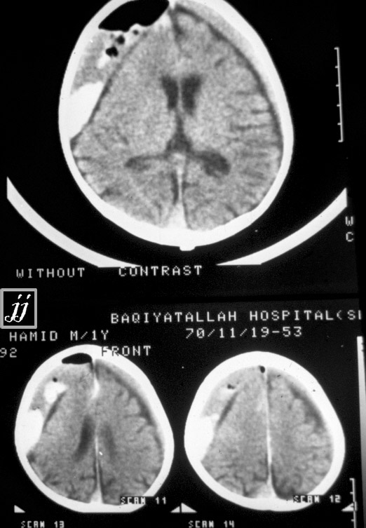 Radioogle | Hematoma – Multiple age subdural hematoma and air inside