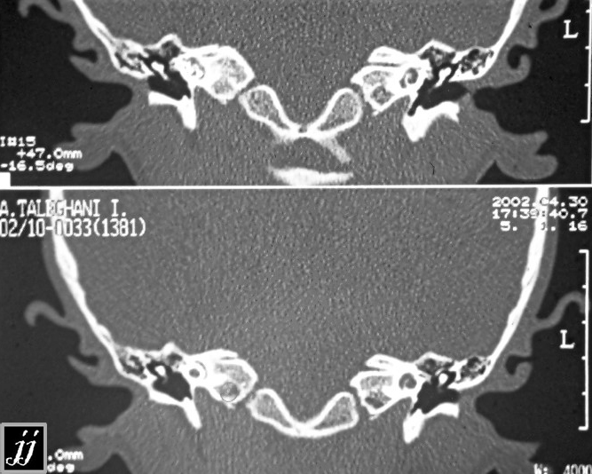 Radioogle | ENT – abnormal right cochlea