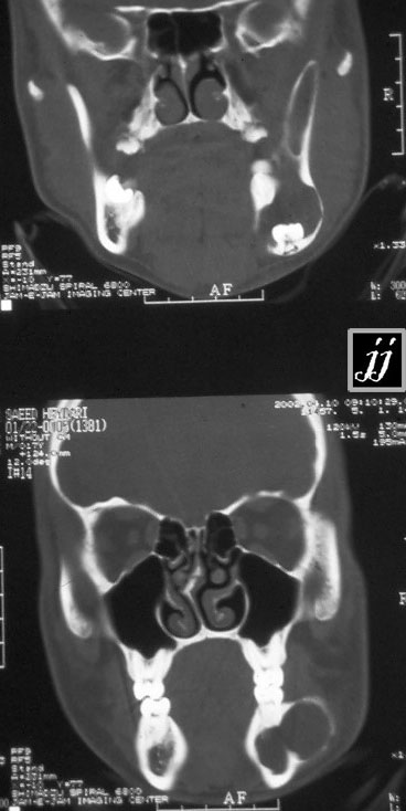 Radioogle | ENT – Mandibular alveolar cyst