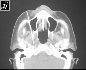 ENT – trigeminal nerve block - Radioogle