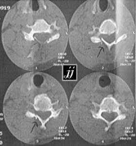 Radioogle | SPINE – Cervical spine lamina fracture