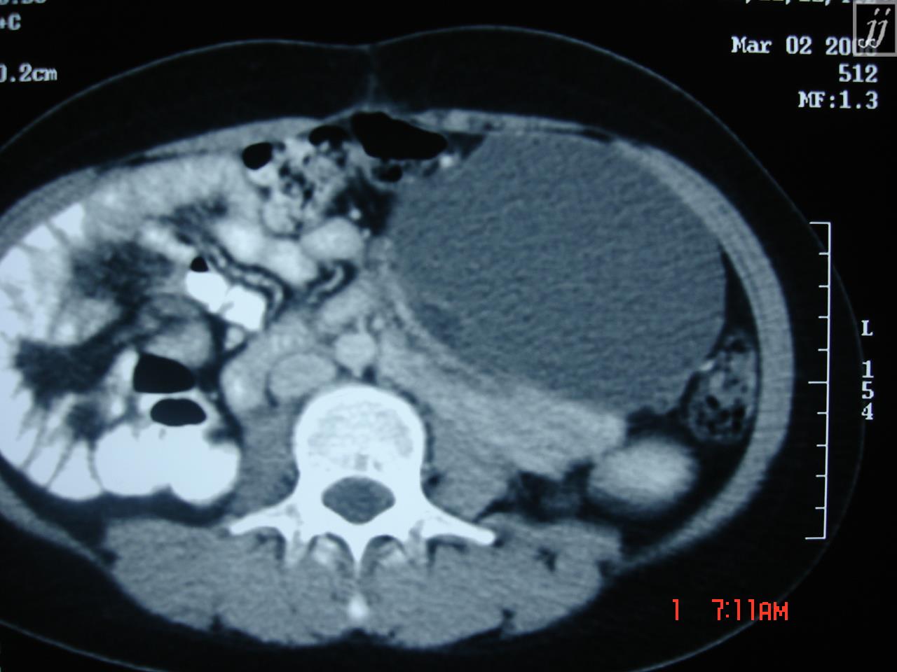 Abdomen – Abdominal wall abscess (11) - Radioogle