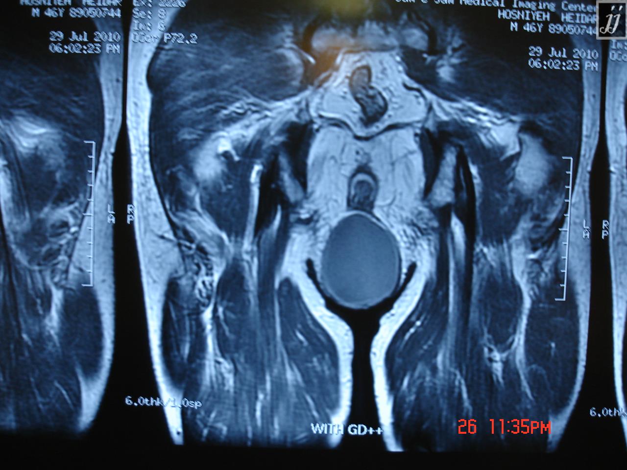 abdomen-perineal-cyst-4-radioogle