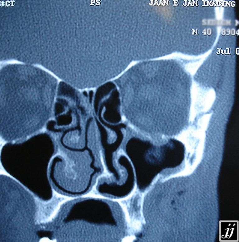 Radioogle | ENT – anterior and posterior lateral maxillary wall ...