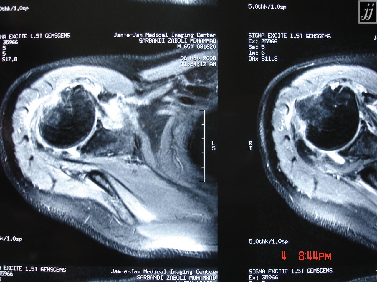 MSK – Lateral Humeral neck defect, fracture (2) - Radioogle