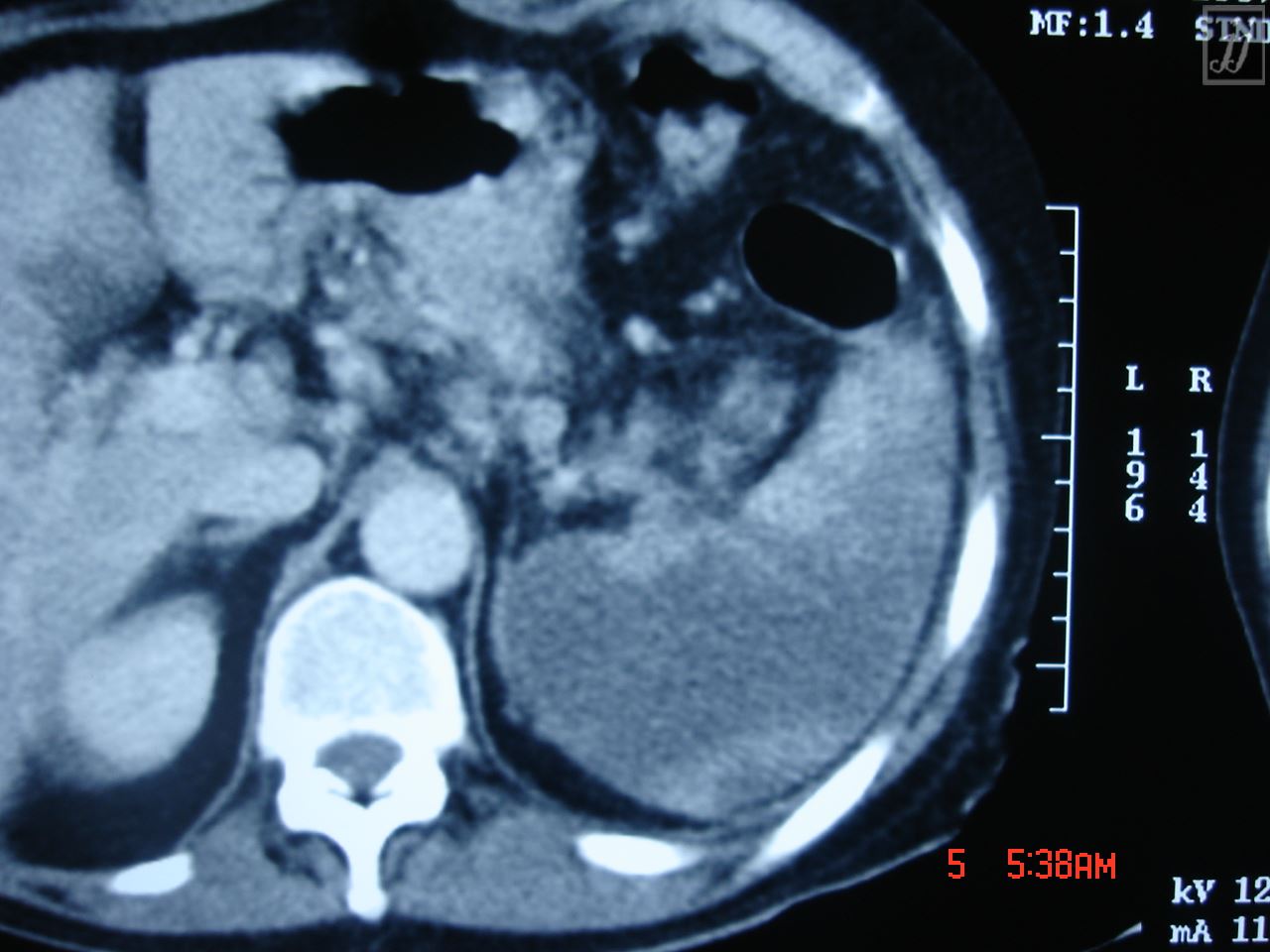 Splenic Rupture Mri abdomen-splenic-infarct-or-rupture-3 - Radioogle