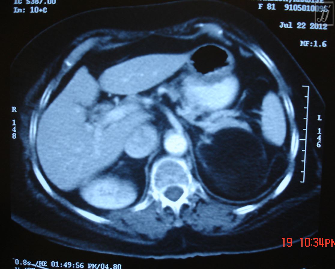 photo of kidneys and bladder