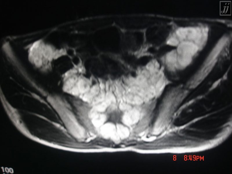 Spine Sacral Tumors Inguinal And Iliac Adenopathies Radioogle