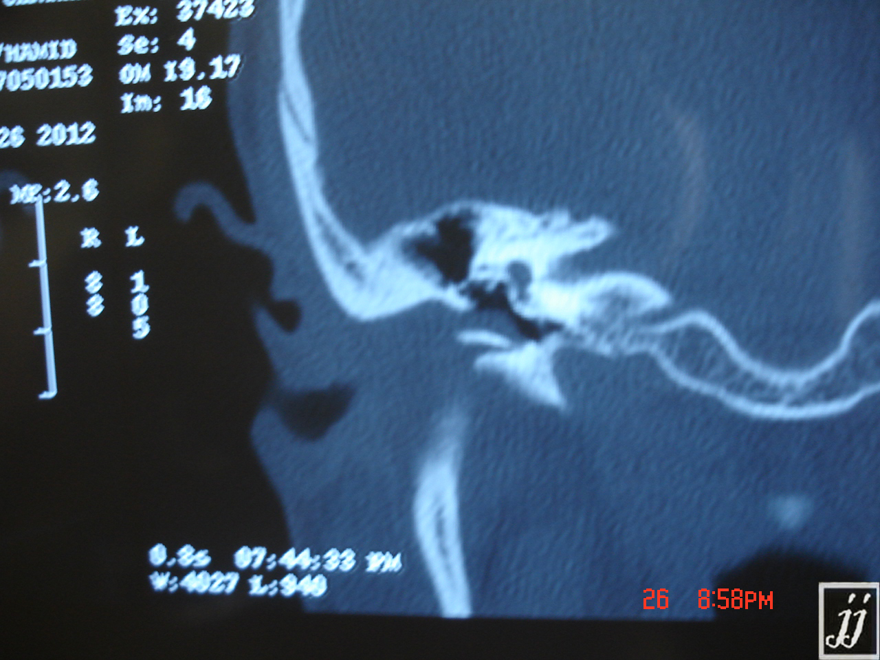 Radioogle Ent External Ear Mass Lesion Entering Middle Ear Condyle