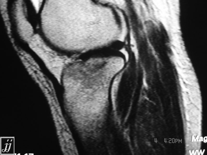 MSK- Tibia fracture, Intra articular hemorrhage and fat fluid level (3 ...