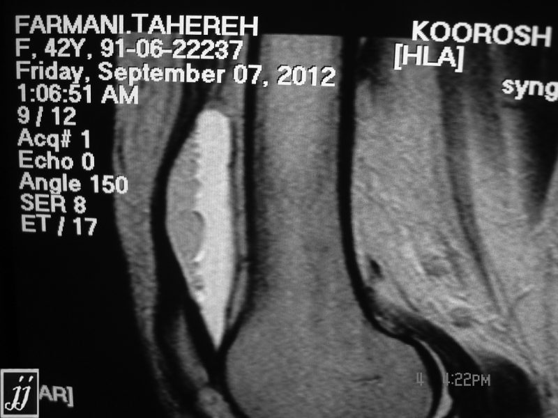 MSK- Tibia fracture, Intra articular hemorrhage and fat fluid level (7 ...