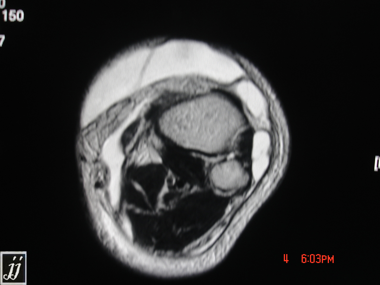 MSK- popliteal cyst and hemorrhage around gastrocnemius muscle and pre ...