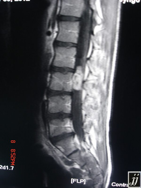 Radioogle | Spine- L3 Intradural extramedullary tumor and intra sacral ...