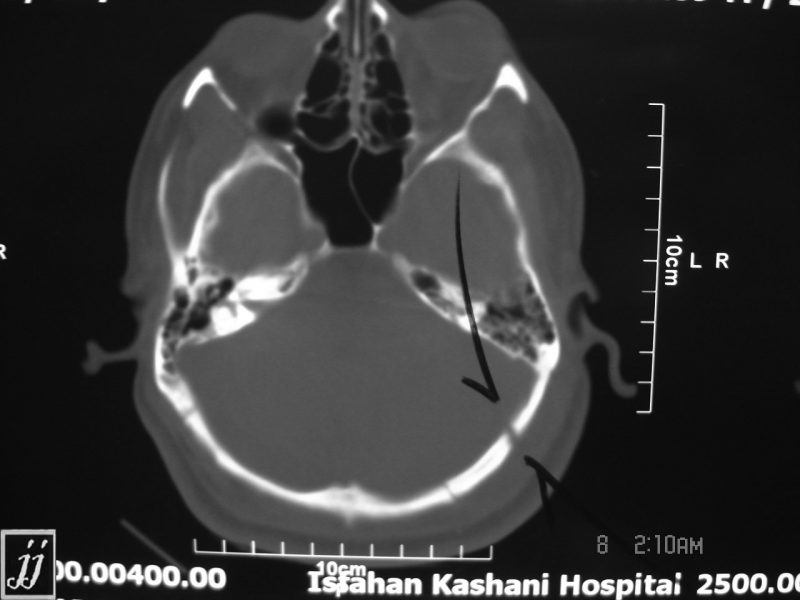 Radioogle Brain occipital bone fracture, subdural hematoma (6)