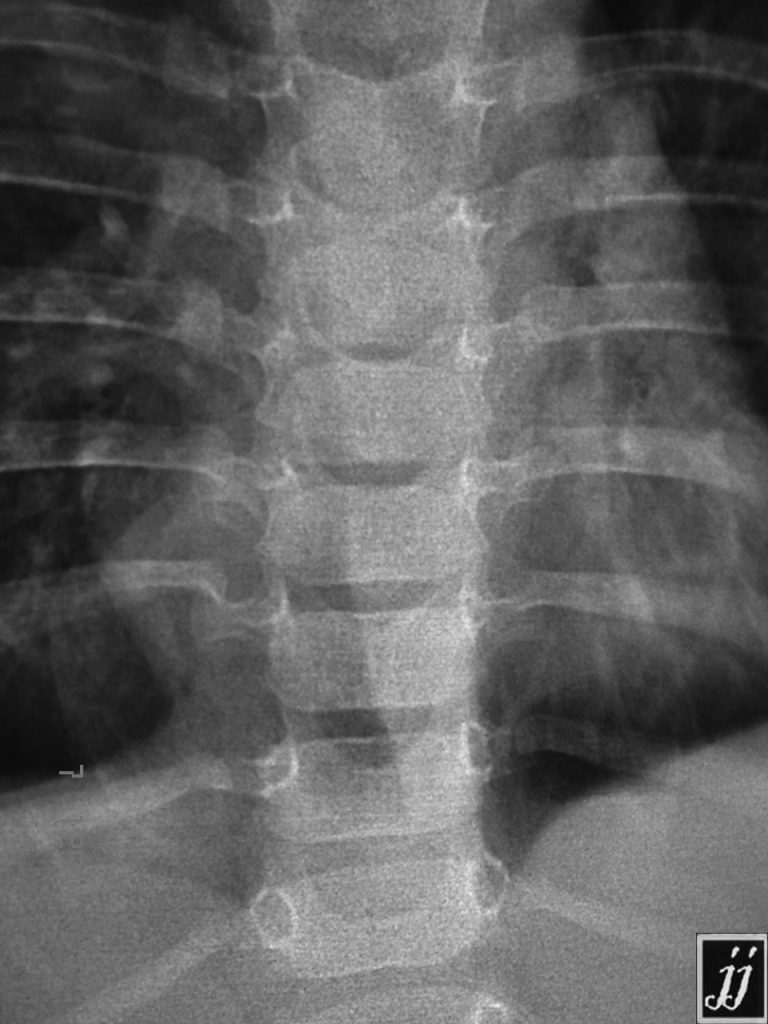 Spine- Dorsal Neurofibroma, dumbbell shape tumor (1) - Radioogle