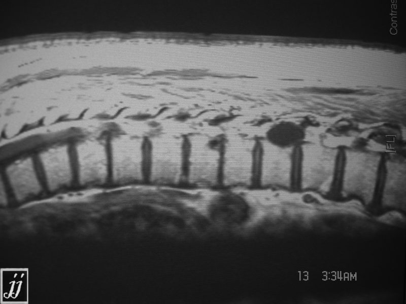 Spine Hydatid Cyst Of Dorsal Spine Radioogle