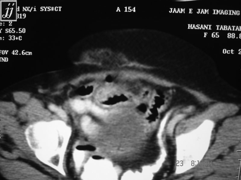 Radioogle | Abdomen- anterior abdominal wall fistula (2)