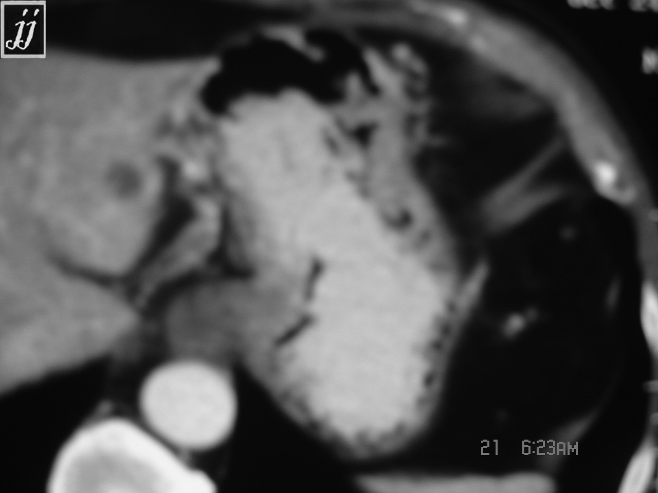 Abdomen- thick gastric wall, gastritis tumor (6) - Radioogle