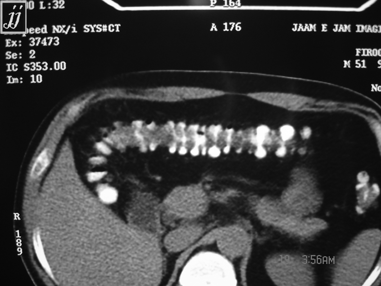 Abdomen- Diverticulosis (1) – Radioogle