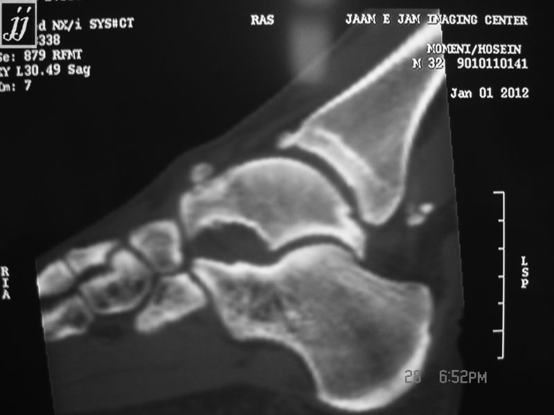 MSK subchondral bone defect of talus and posterior tibia talar loose