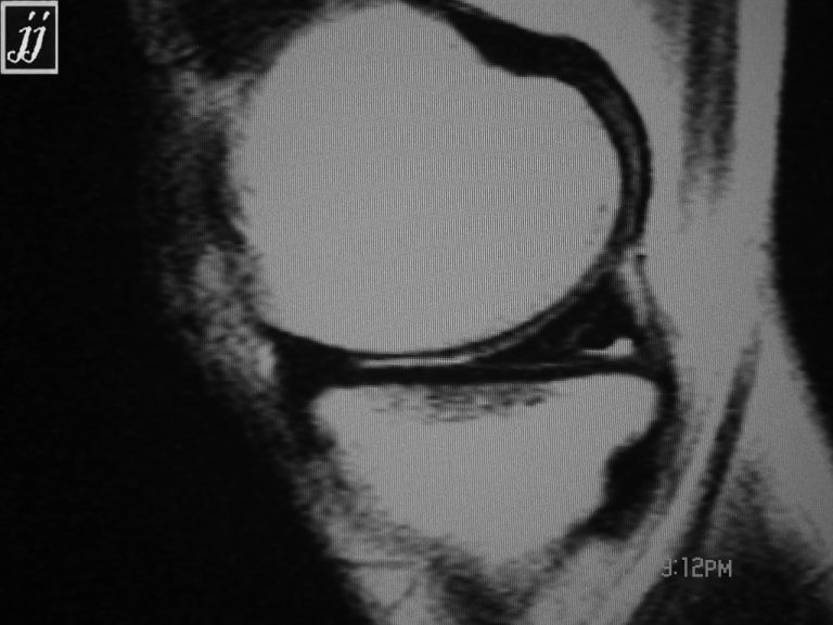 Radioogle MSK Posterior Horn Of Medial Menisci Is Torn And Lateral Tibial Plateau Fracture 3