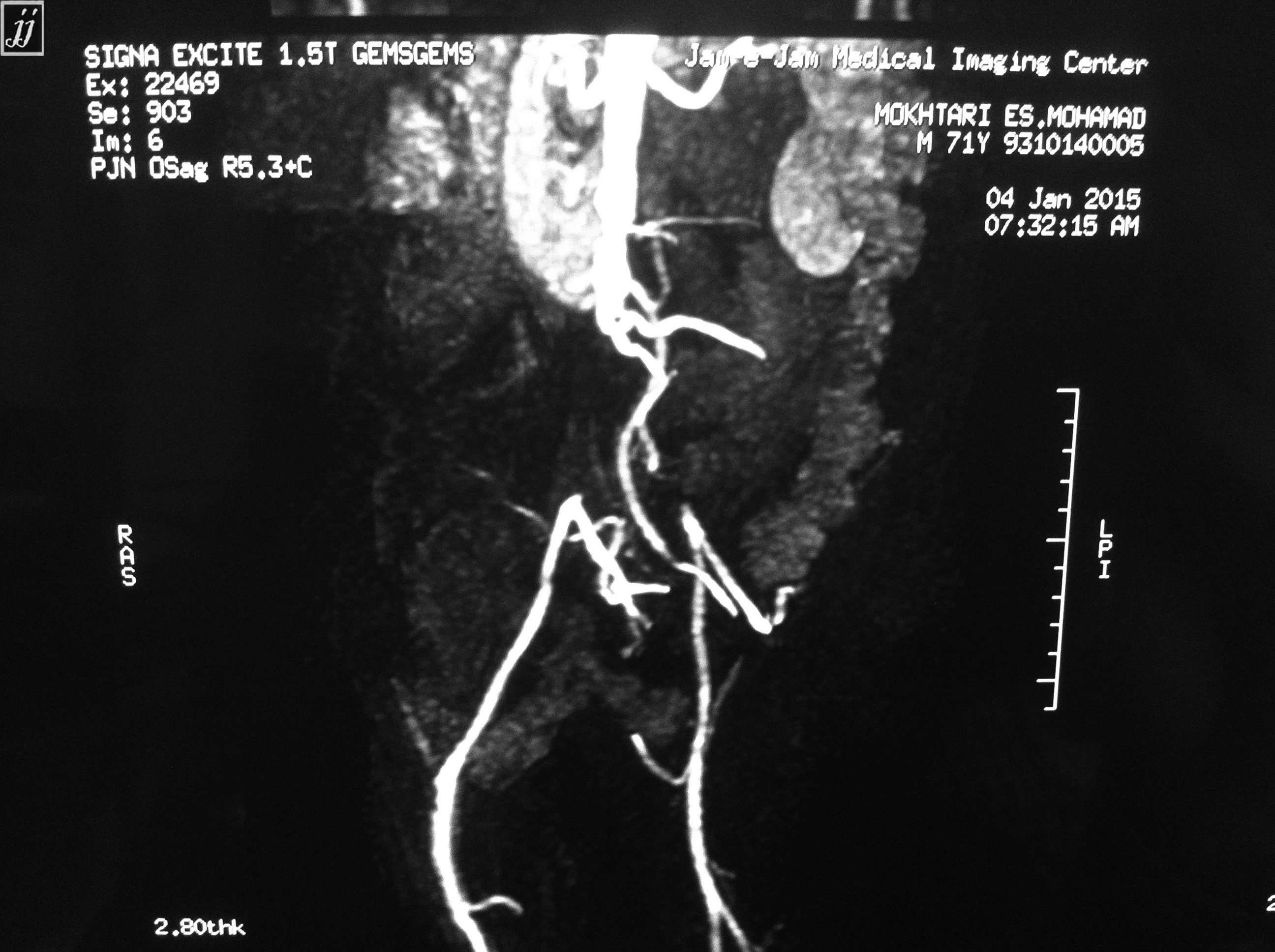 Radioogle | Abdomen- abdominal aorta angiography, leriche syndrome (1)