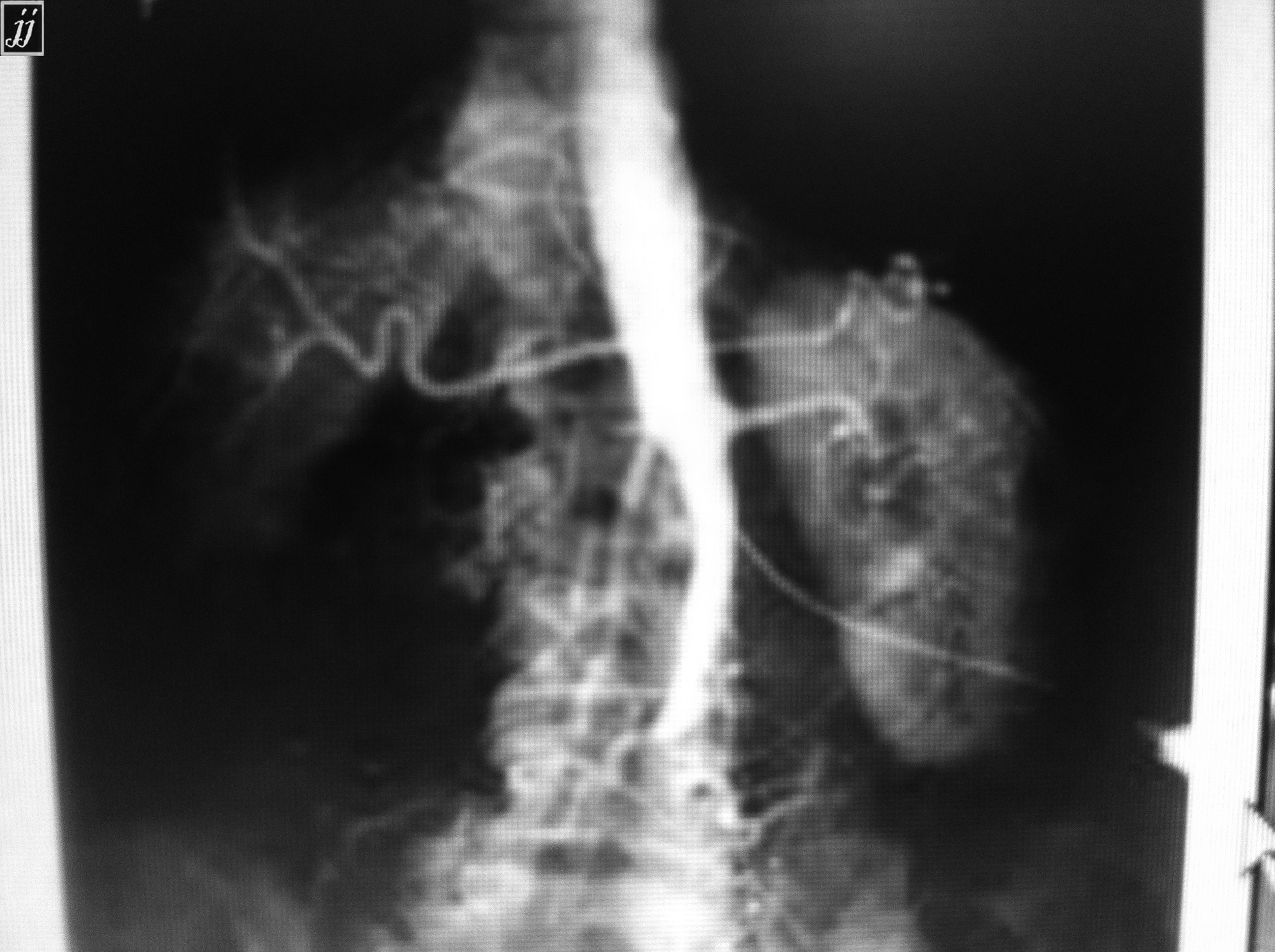 Radioogle | Abdomen- abdominal aorta angiography, leriche syndrome (4)