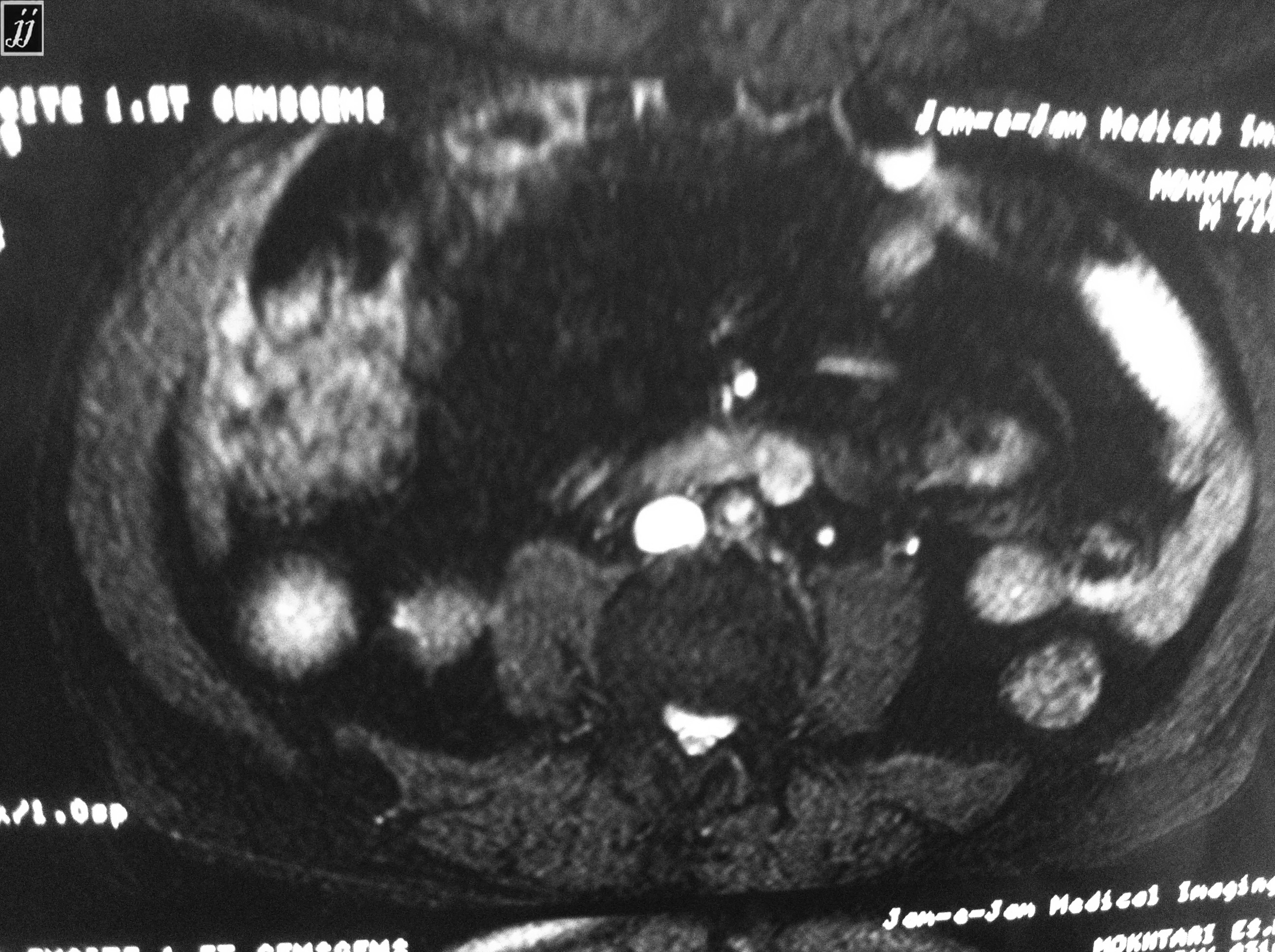 Radioogle | Abdomen- abdominal aorta angiography, leriche syndrome (7)