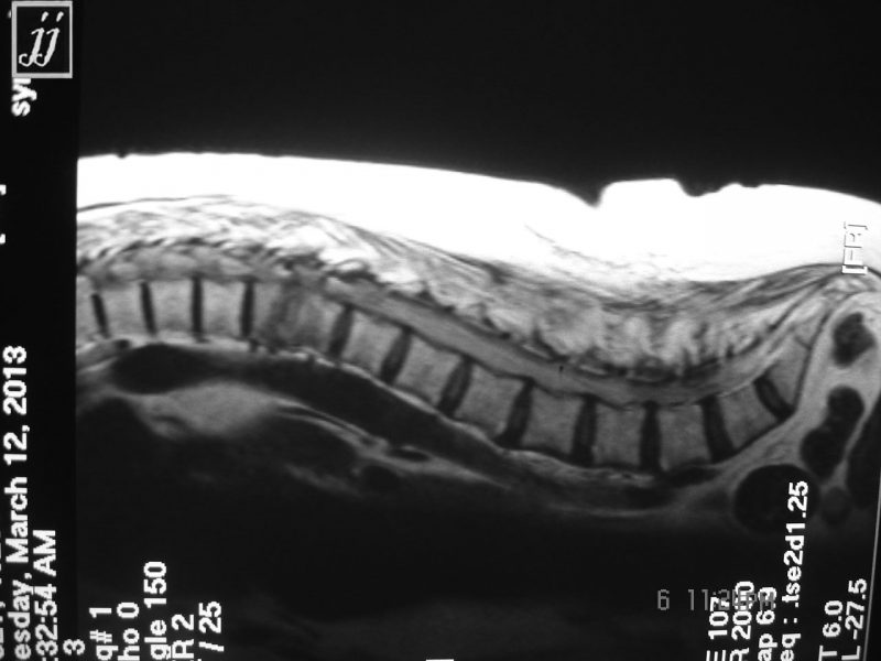 Radioogle | Spine- Atrophic para spinal muscle and replacement by fat ...