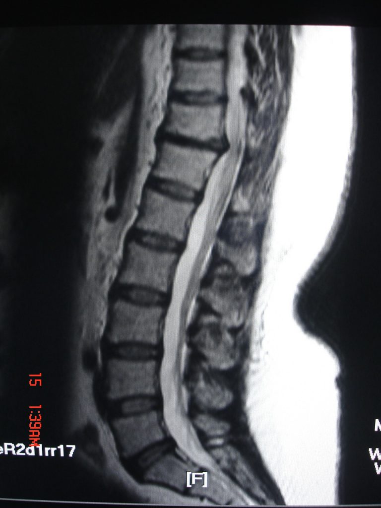 Spine- D11 D12 disc herniation and D10 D11 facet enlargement - Radioogle