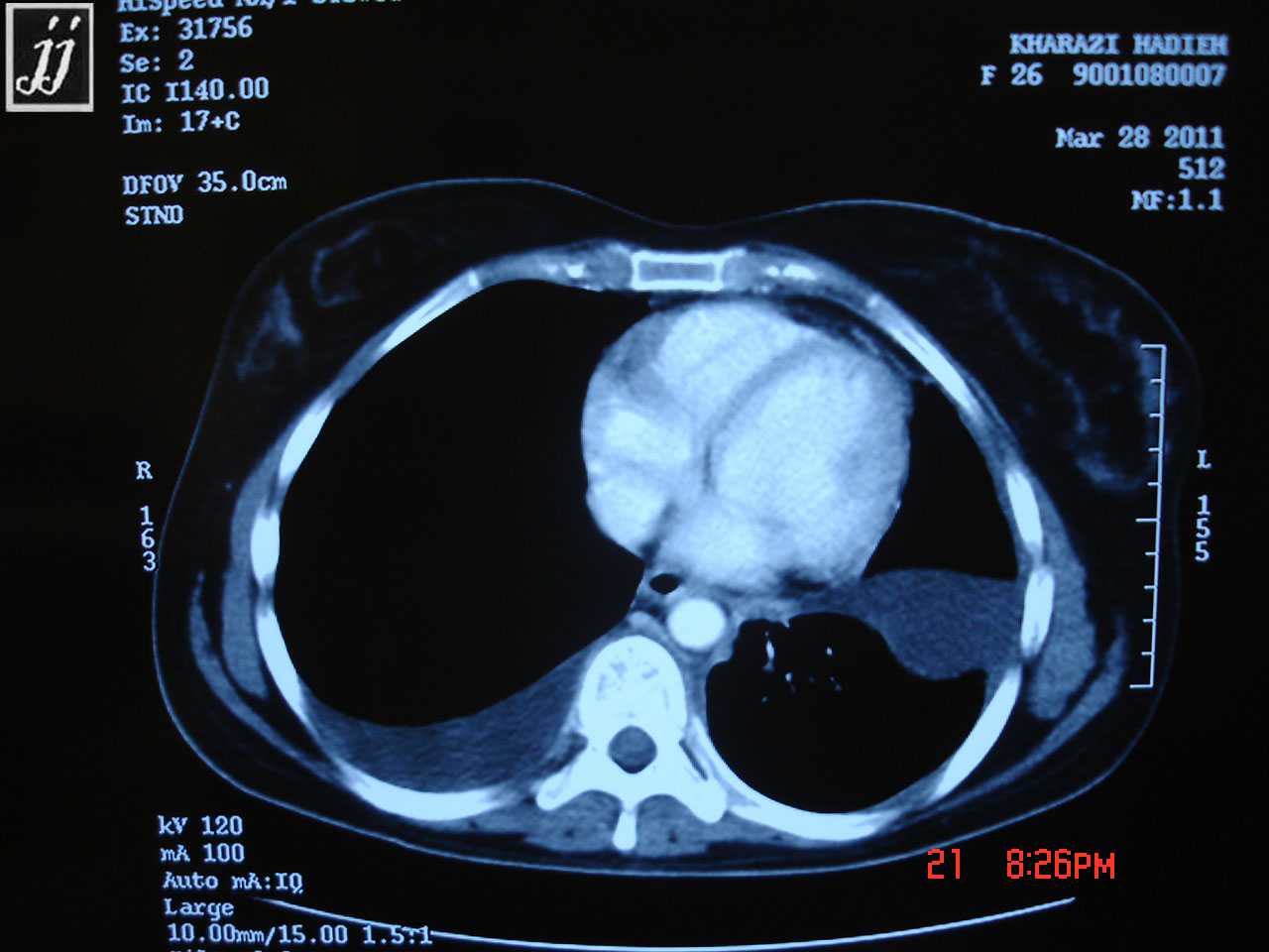Radioogle Abdomen infiltrated retro peritoneum around aorta and due