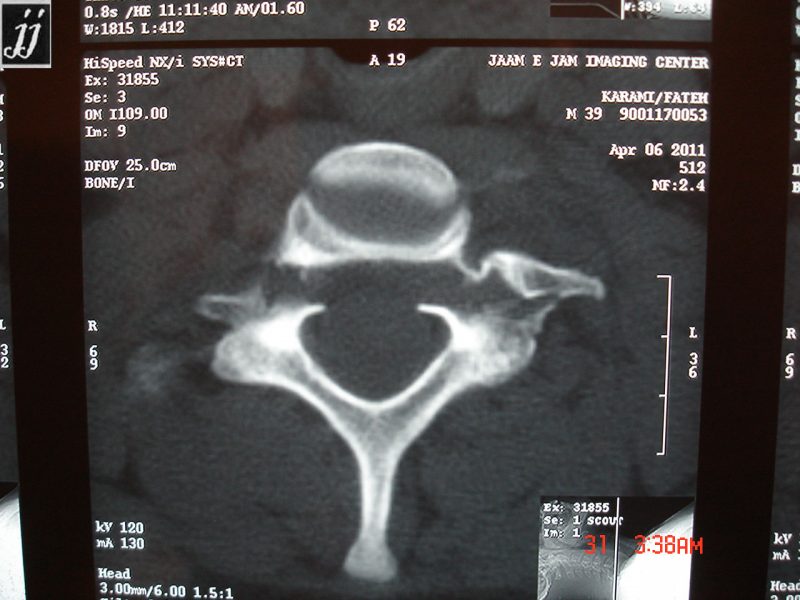 Spine- pedicular fracture in cervical spine (4) - Radioogle