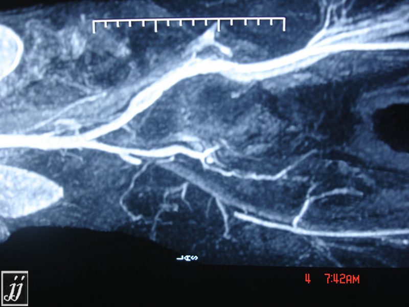 Vascular- Pelvis MRA, obstructed right iliac vessels (3) - Radioogle