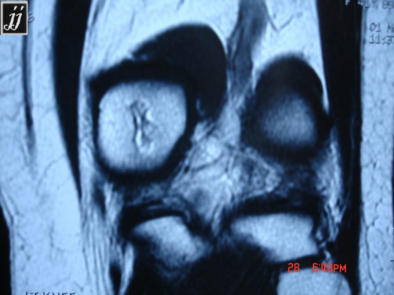 MSK- distal femoral bone infarct (8) - Radioogle