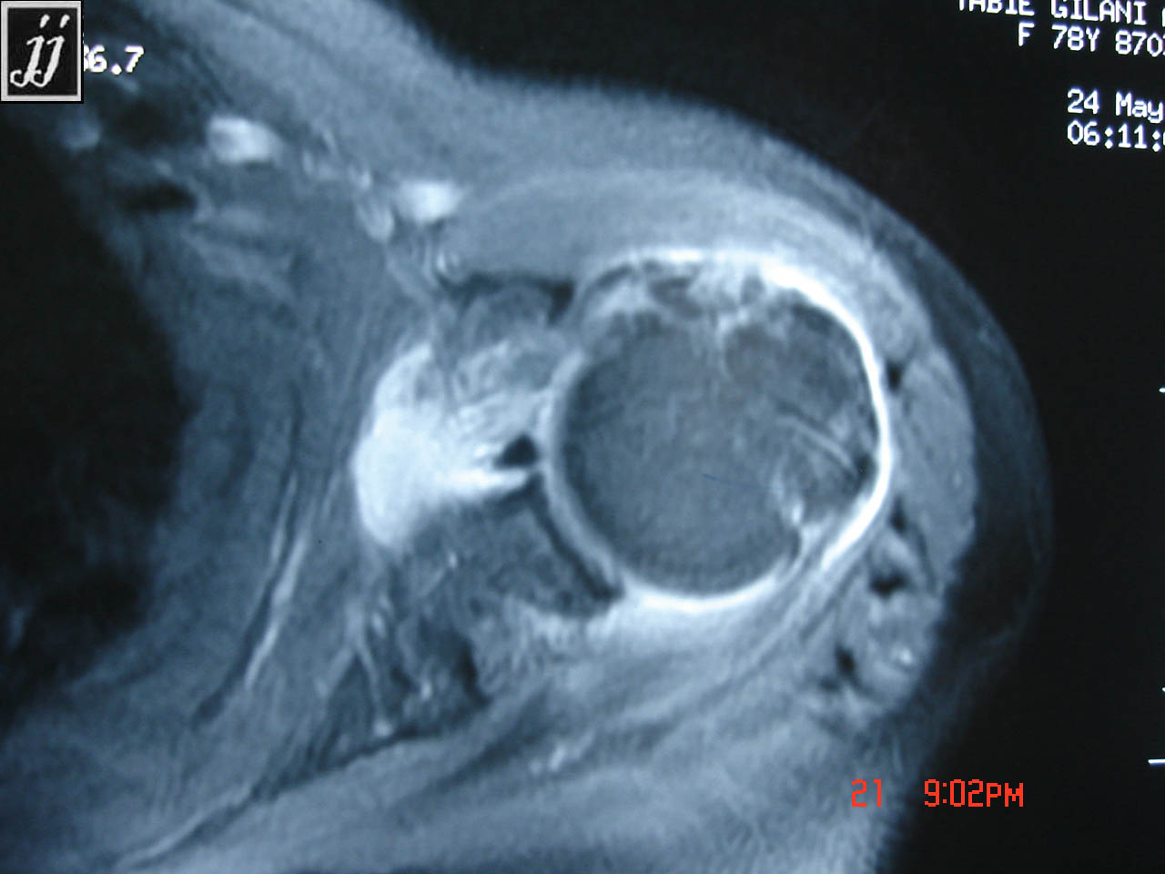 Rotator Labrum MSK- rotator cuff tear and fluid collection in subacromial space ...
