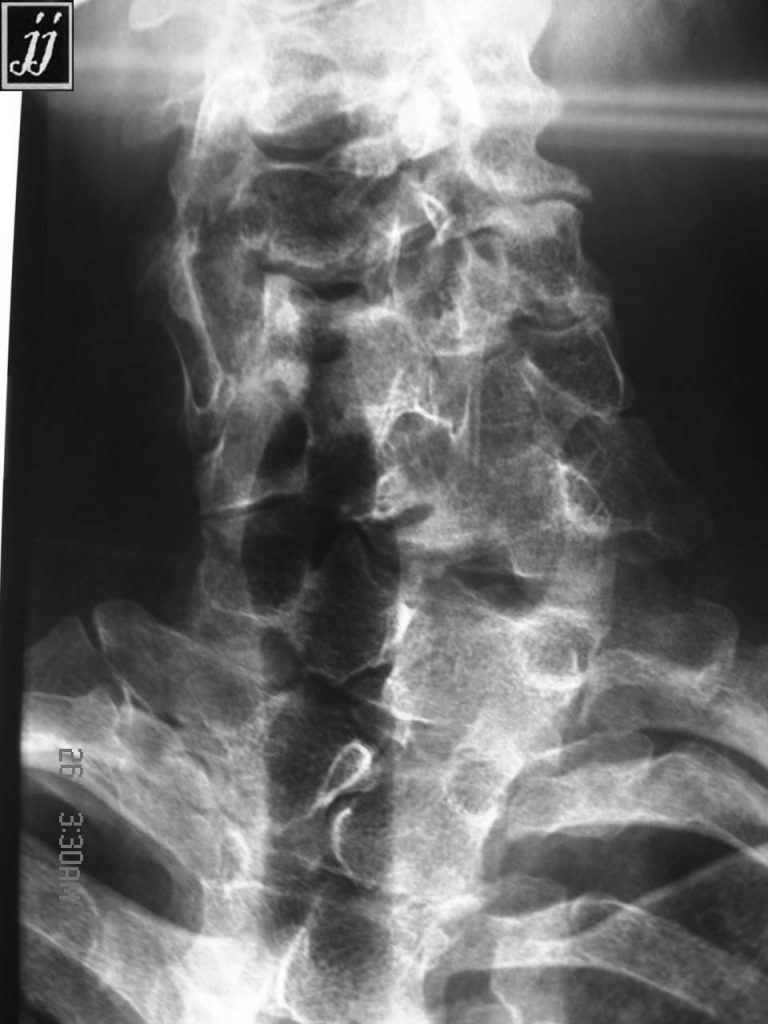 Spine- cervical spine vertebral anomalies as hemi vertebral and butter ...