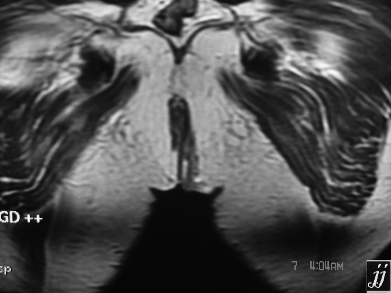 Abdomen- left perineal fistula and sinus tract (10) – Radioogle