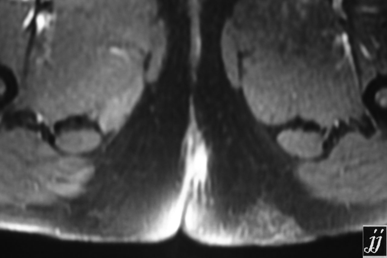 Radioogle | Abdomen- left perineal fistula and sinus tract (2)