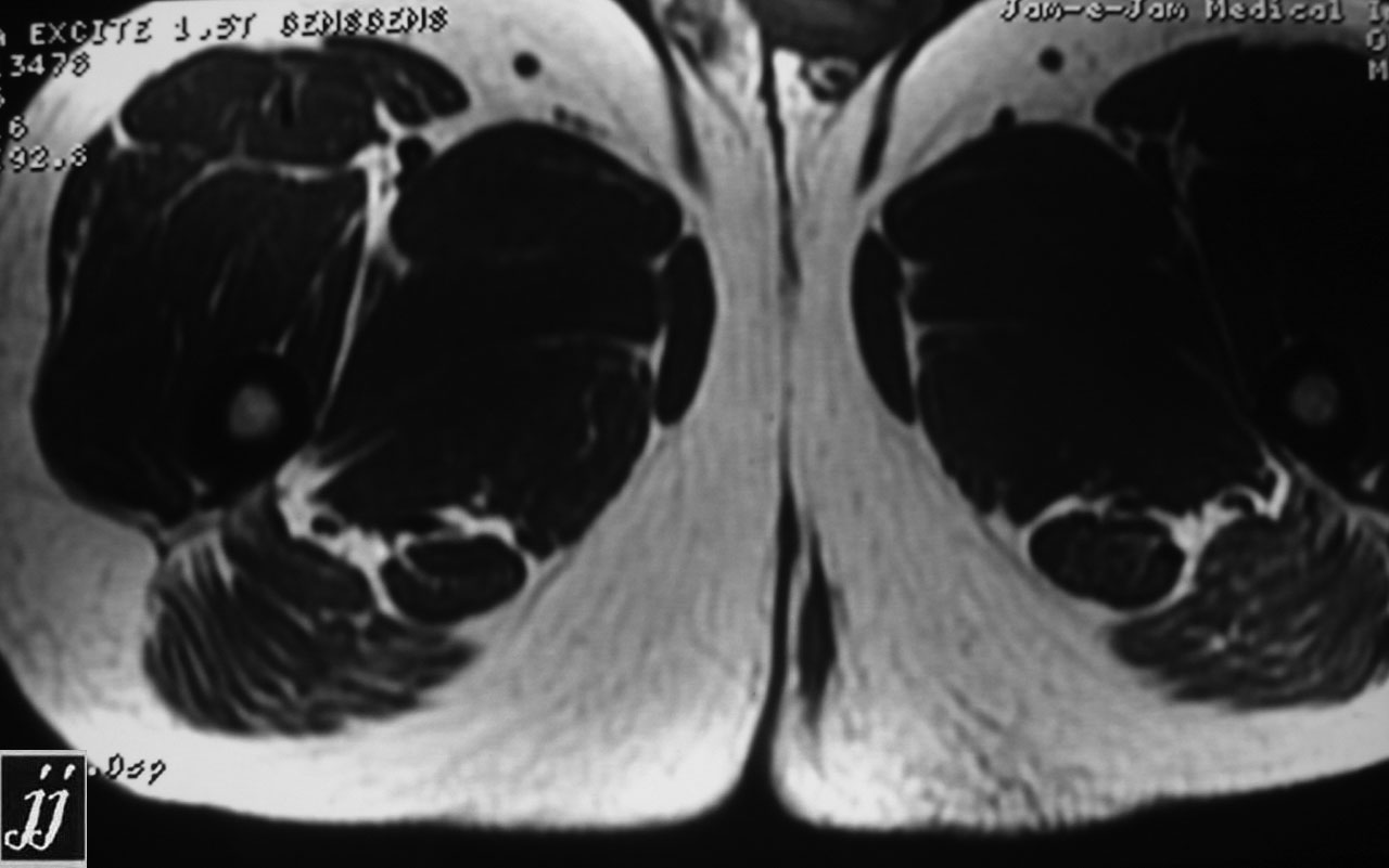 Radioogle | Abdomen- left perineal fistula and sinus tract (5)