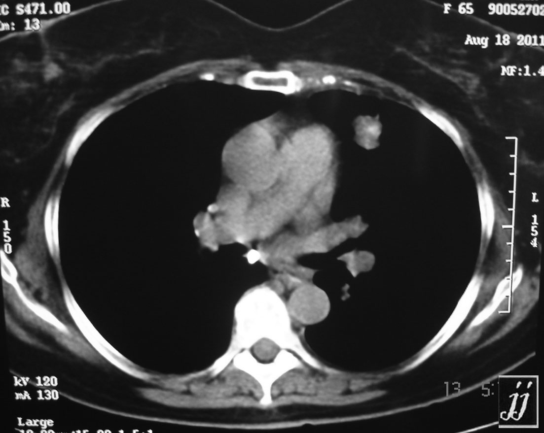 Radioogle | Abdomen- pulmonary nodule (2)