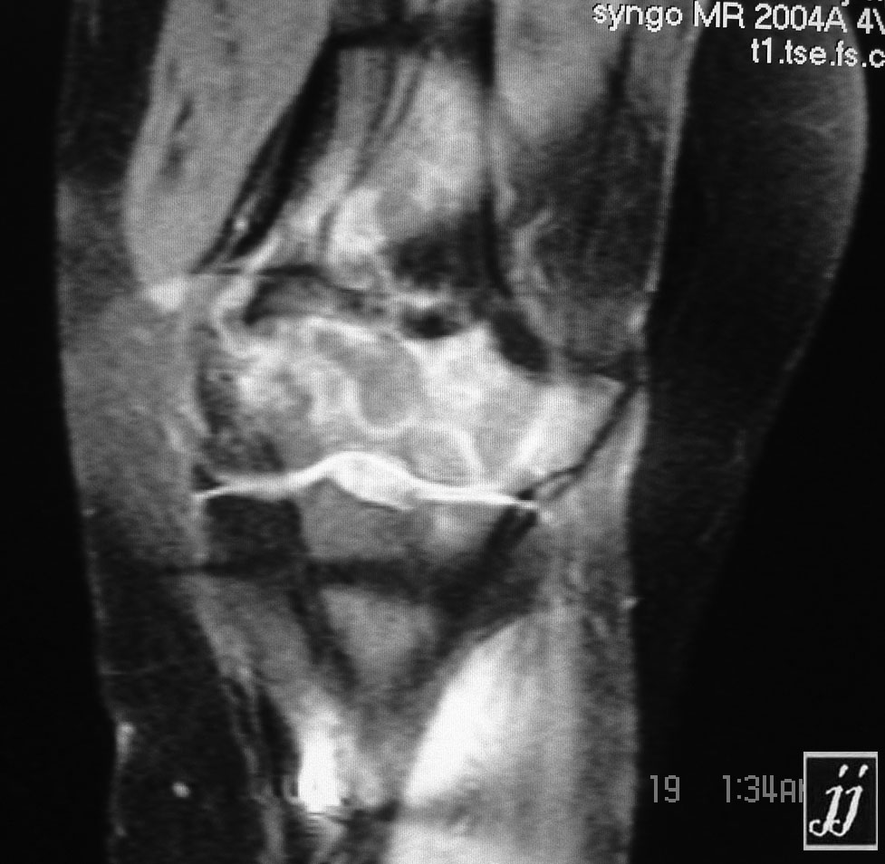 MSK- femoral bone infarct (6) - Radioogle